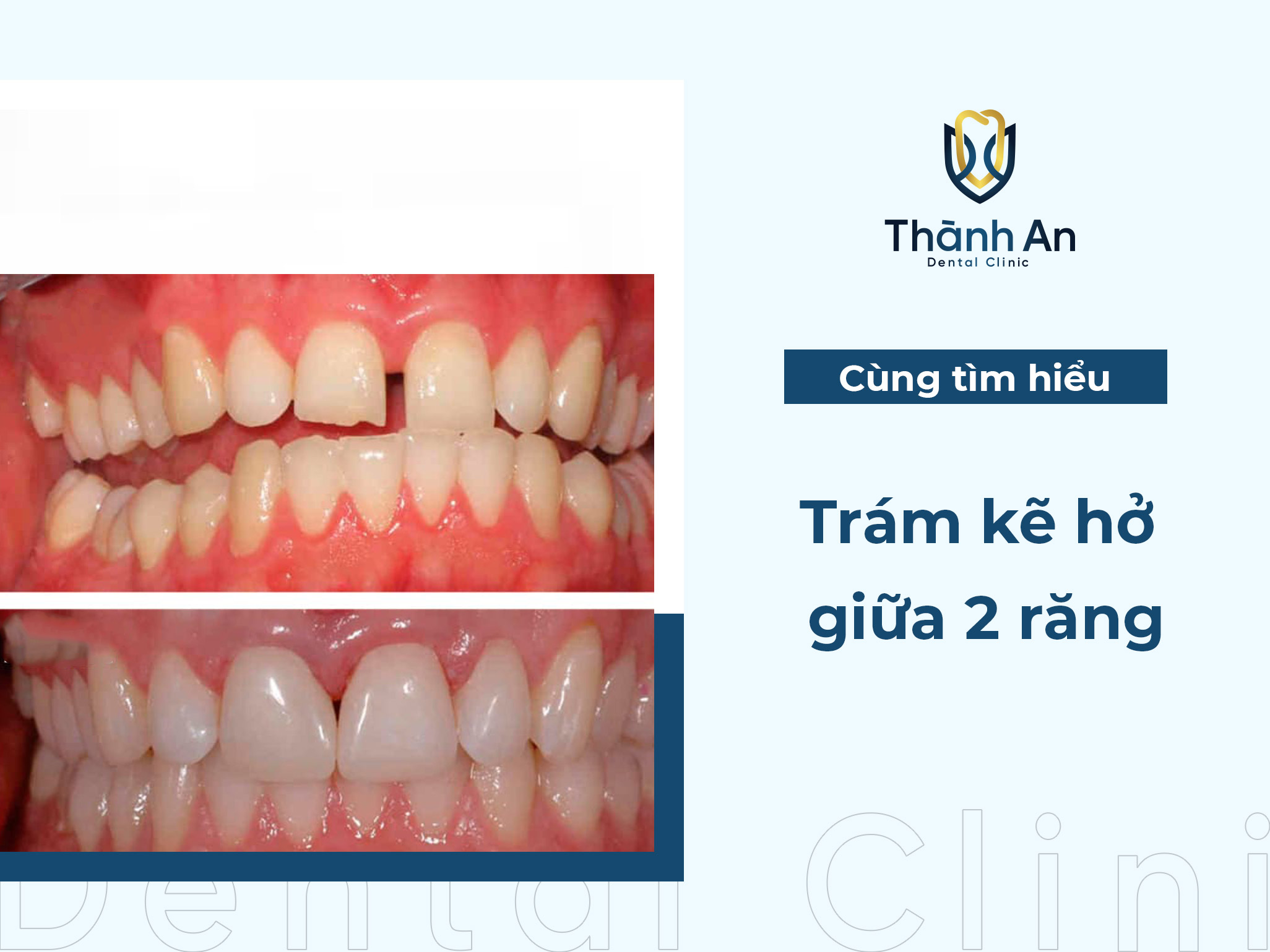 Trám kẽ hở giữa 2 răng - Khôi phục thẩm mỹ cho nụ cười tự tin