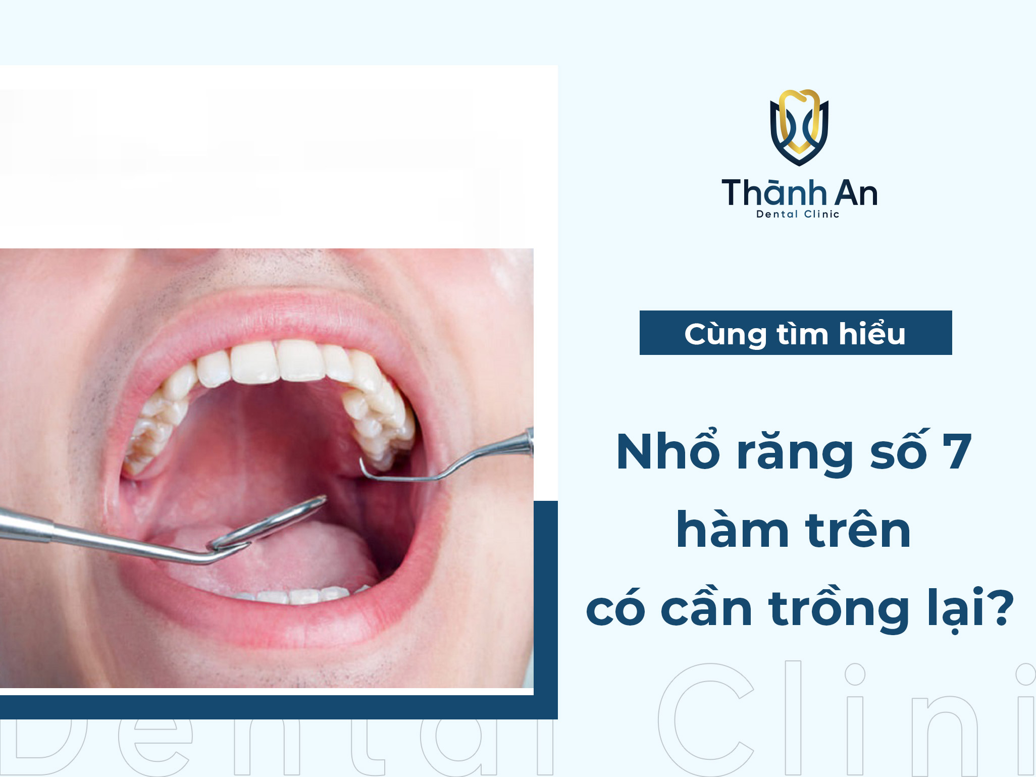 [Hỏi Đáp] Nhổ răng số 7 hàm trên có cần trồng lại không?
