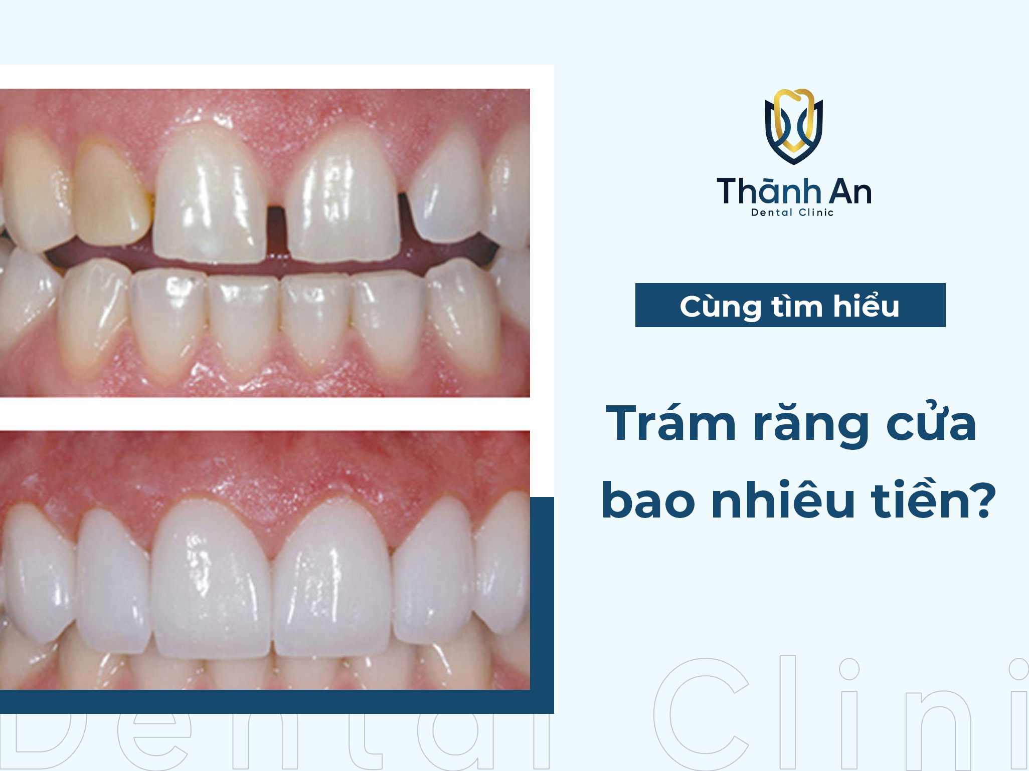 Trám răng cửa bao nhiêu tiền? 