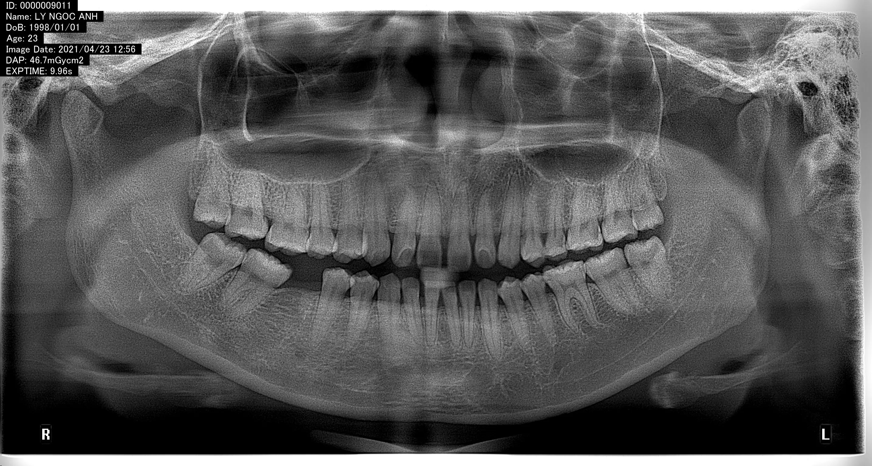 truoc-khi-cam-implant-thay-the-rang-so-6