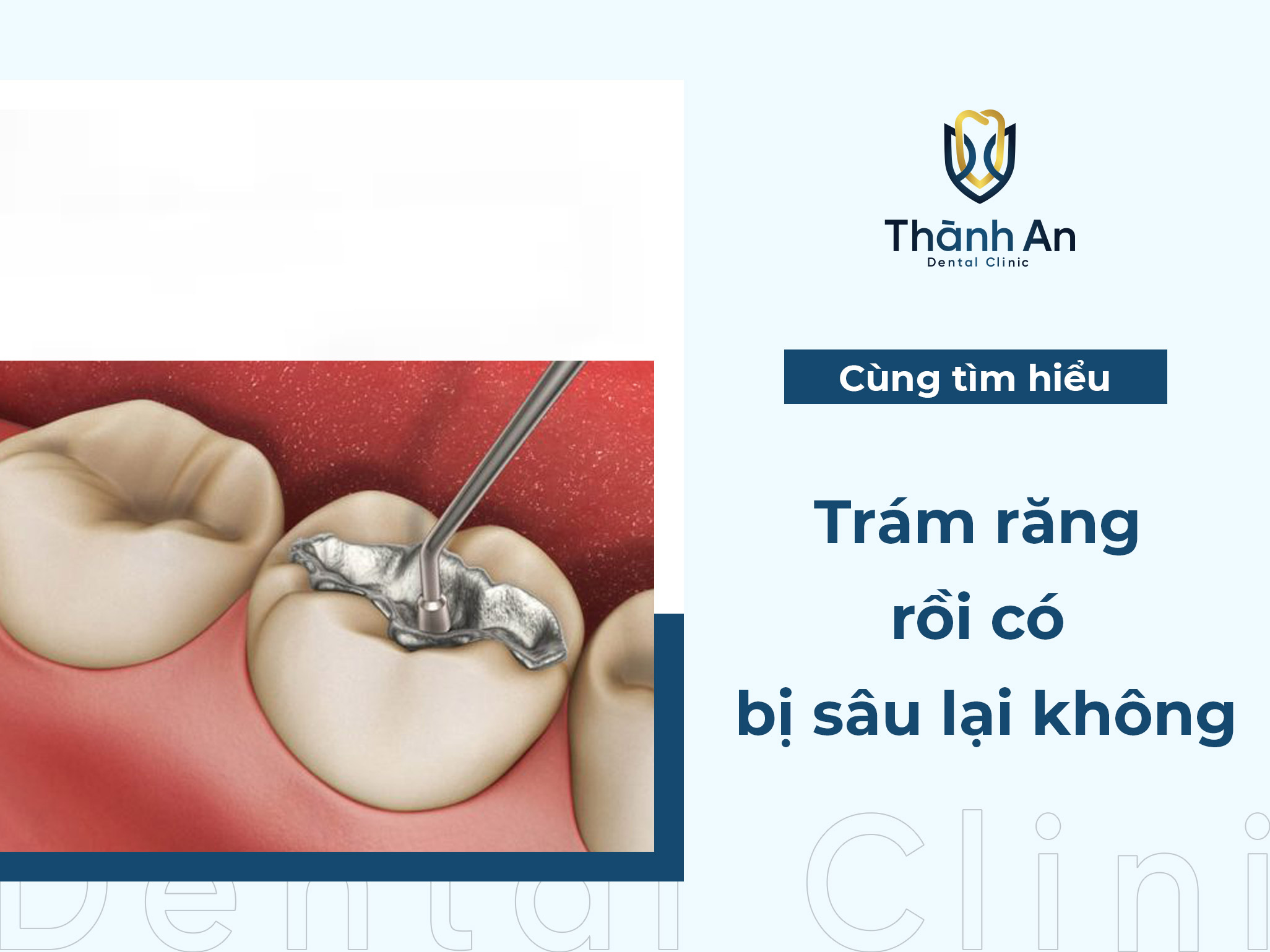 [Thắc Mắc] Trám răng rồi có bị sâu lại không?
