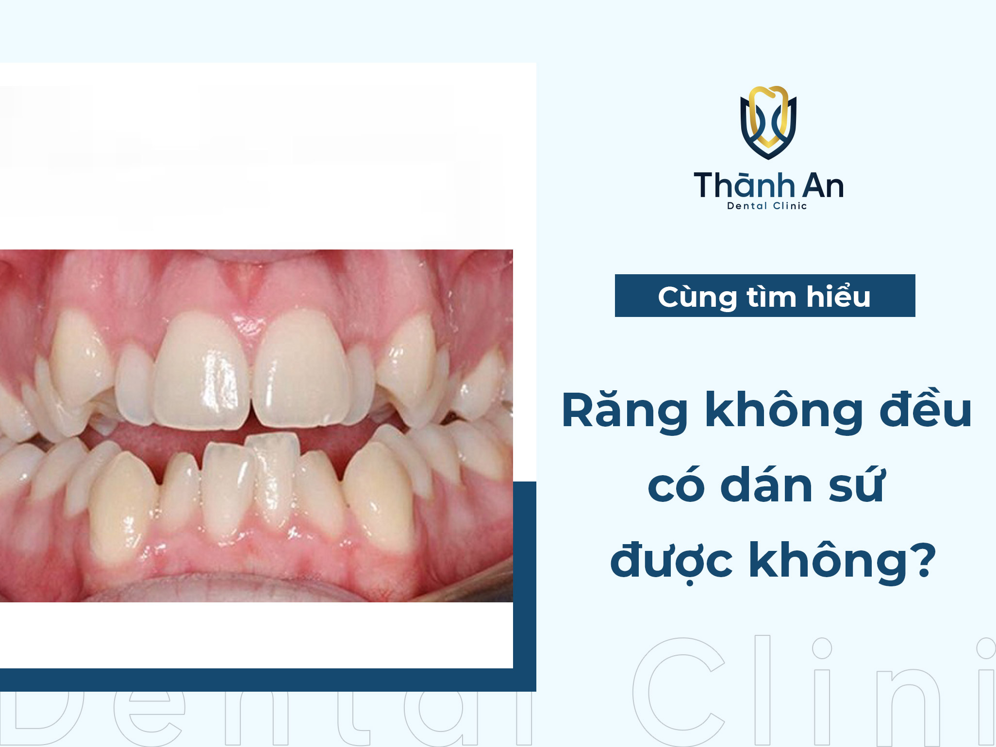 [Hỏi - Đáp] Răng không đều có dán sứ được không?