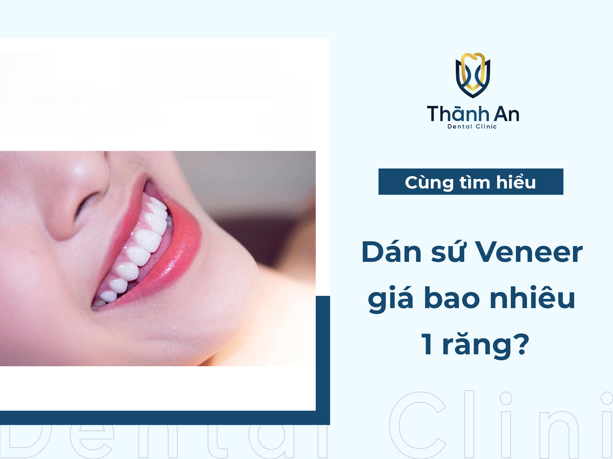 Dán sứ Veneer giá bao nhiêu 1 răng?  [Bảng giá 2024]
