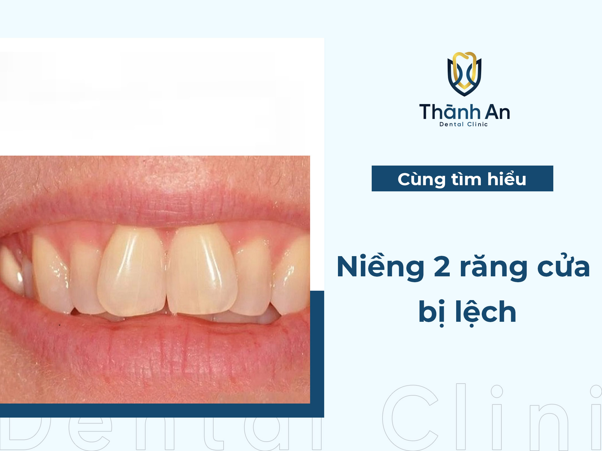 Giải pháp niềng 2 răng cửa bị lệch nhanh chóng và tiết kiệm