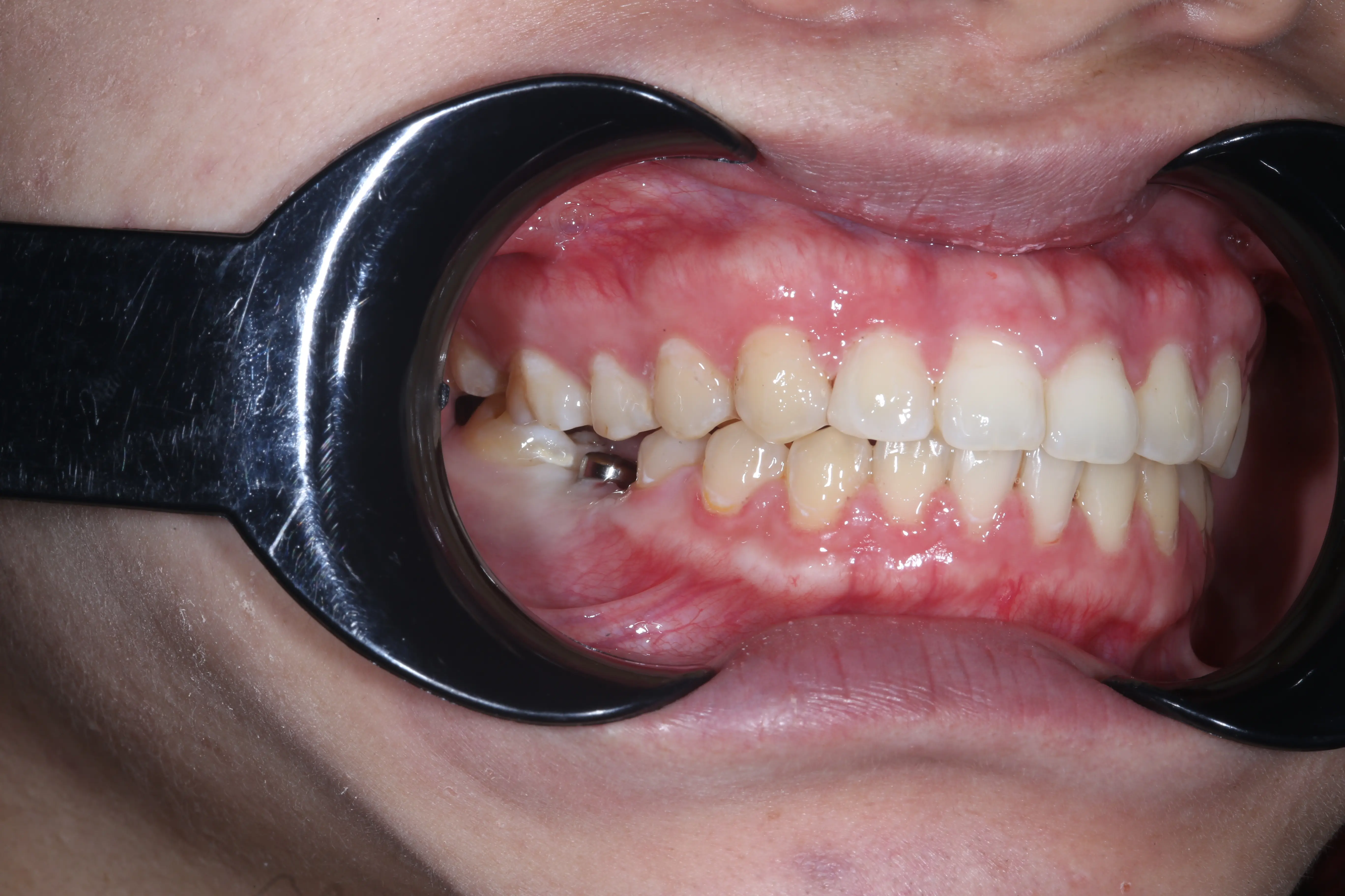 cam-implant-phuc-hoi-rang-so-6.webp