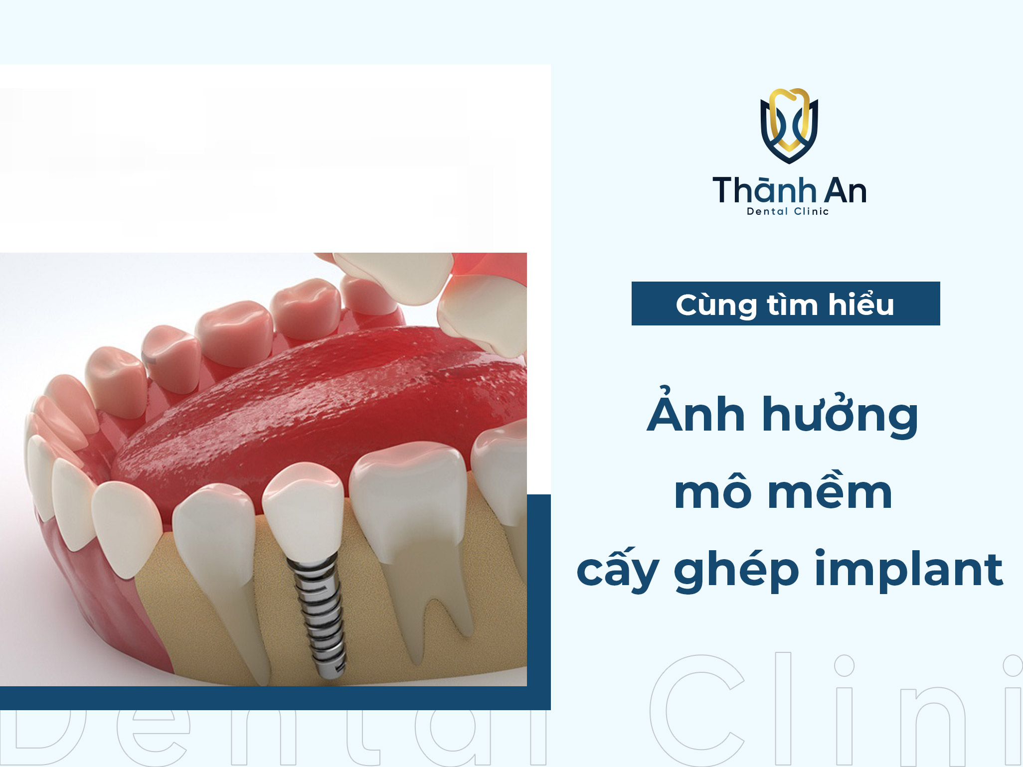 Ảnh hưởng của mô mềm đến thành công của cấy ghép implant