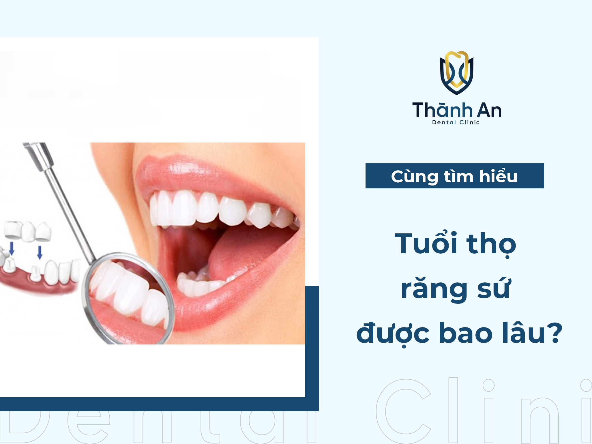 [Hỏi - Đáp] Tuổi thọ răng sứ được bao lâu?
