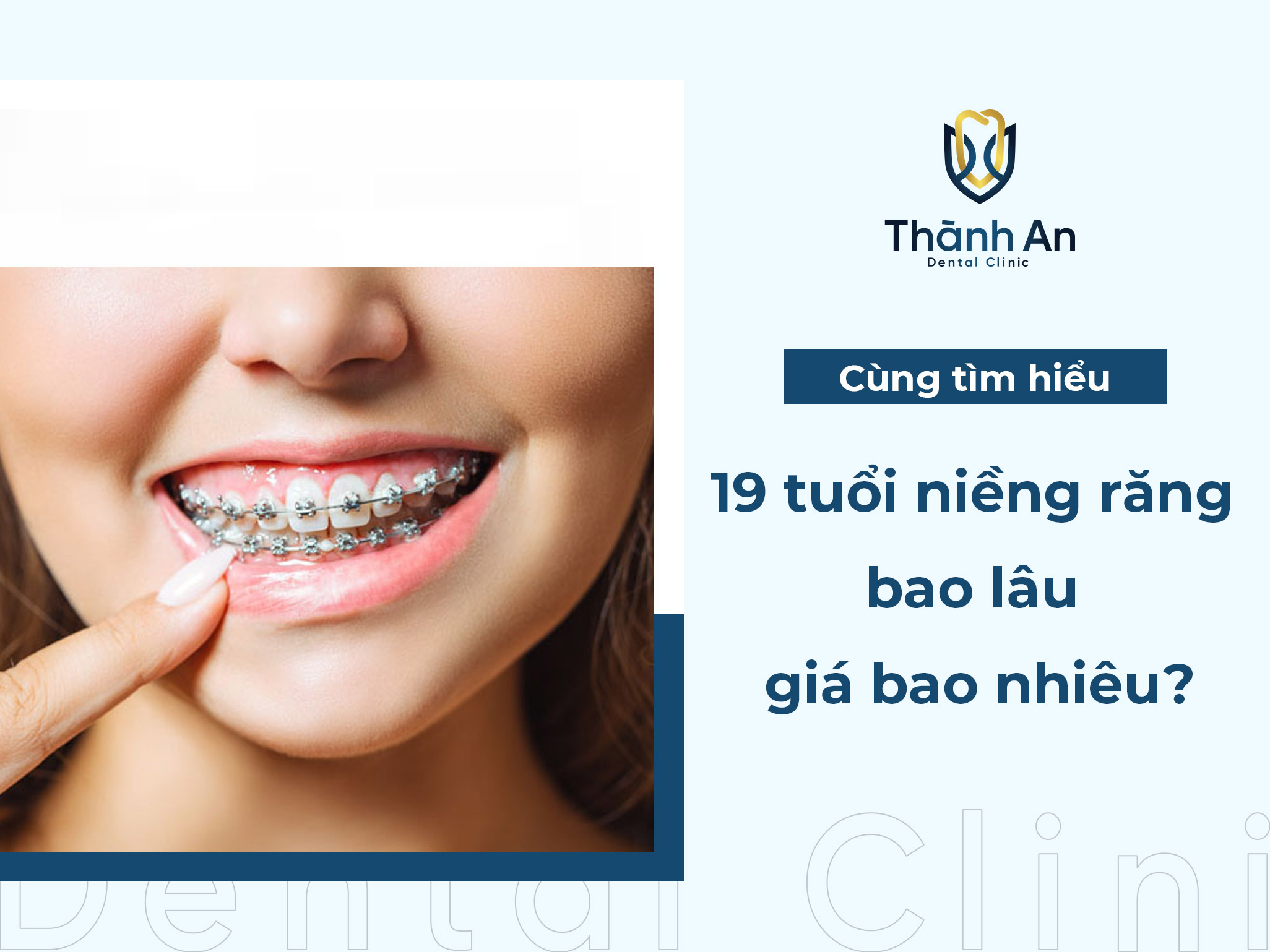 19 tuổi niềng răng bao lâu thì tháo niềng và giá bao nhiêu?
