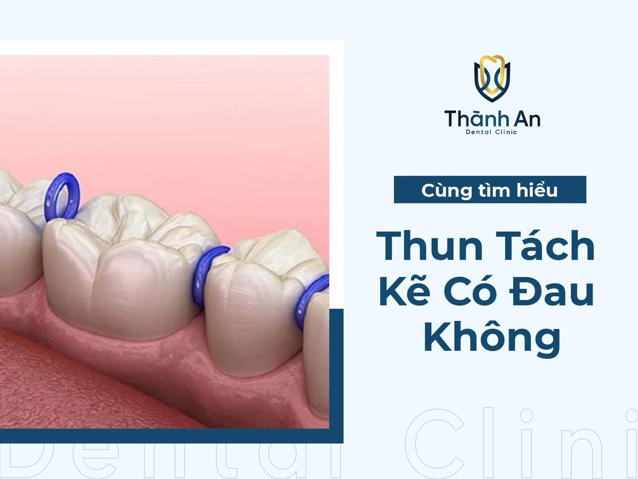 Đặt Thun Tách Kẽ Có Đau Không? Giảm Đau Hiệu Quả
