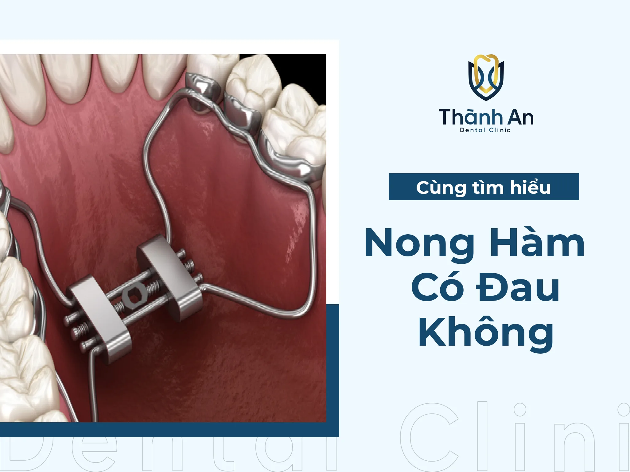 Nong Hàm Có Đau Không? Có Ảnh Hưởng Tới Ăn Uống Không