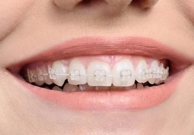 niềng răng mắc cài sứ