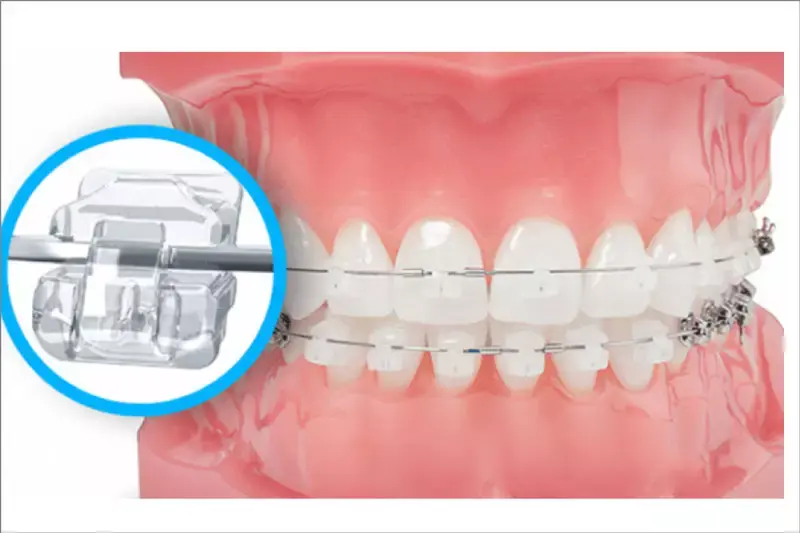 niềng răng mắc cài sứ