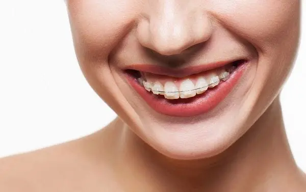niềng răng mắc cài sứ