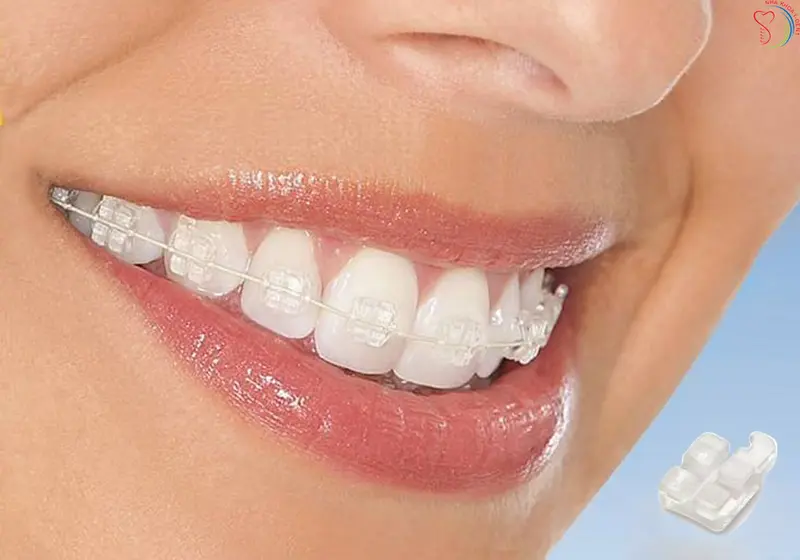 mắc cài sứ tự buộc