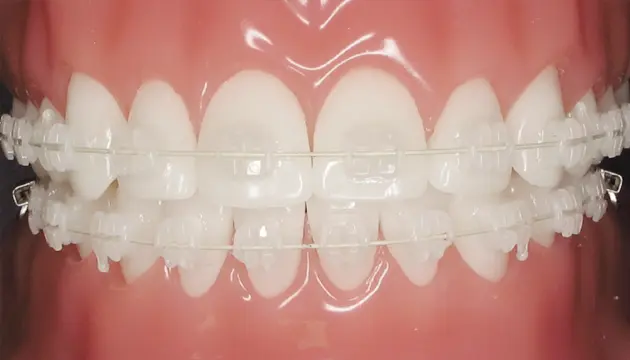 mắc cài sứ tự buộc