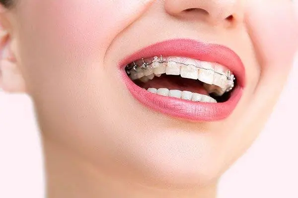 mắc cài sứ tự buộc