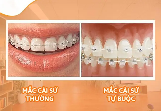 mắc cài sứ tự buộc