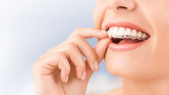 niềng răng trong suốt