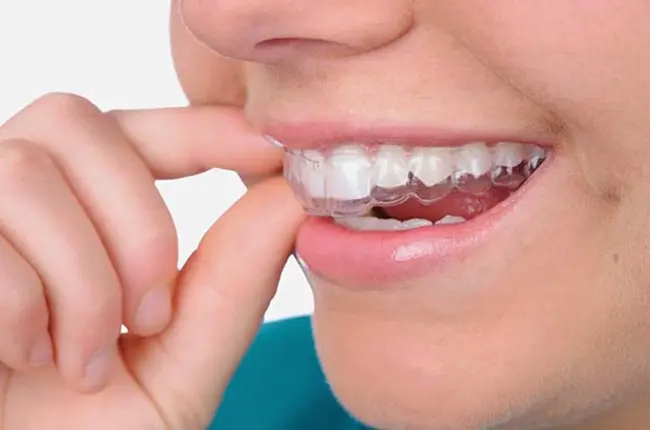 niềng răng trong suốt