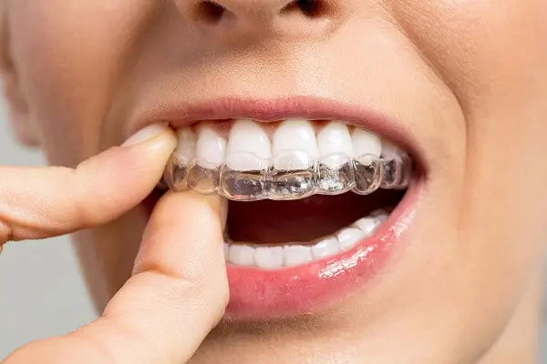 niềng răng trong suốt