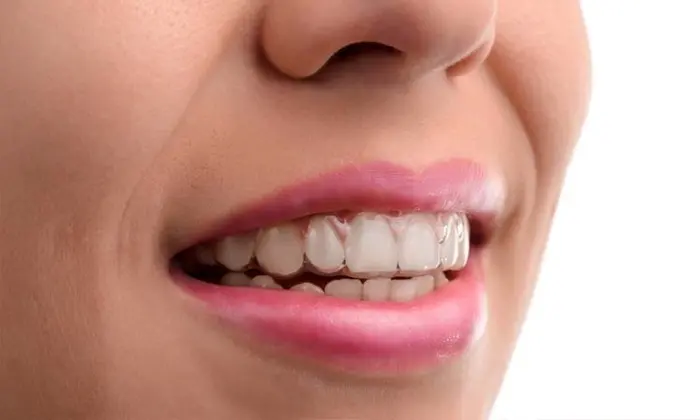 niềng răng invisalign