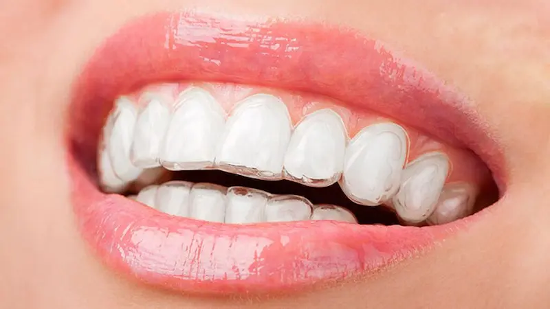 niềng răng invisalign