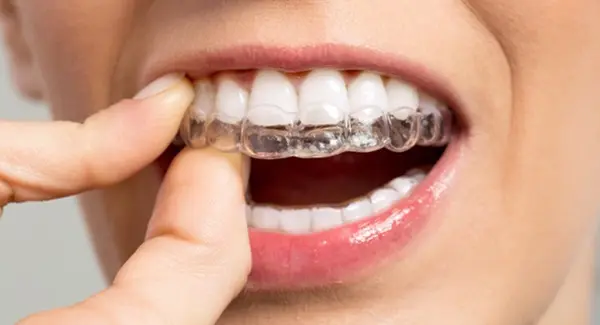 niềng răng invisalign