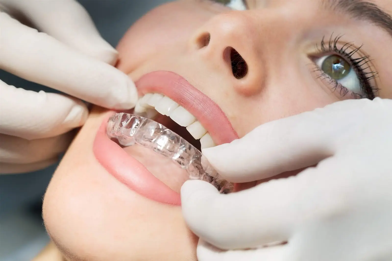 niềng răng invisalign