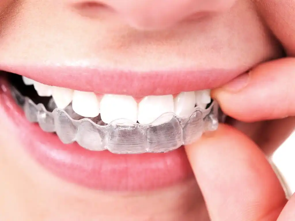 niềng răng trong suốt invisalign giá bao nhiêu