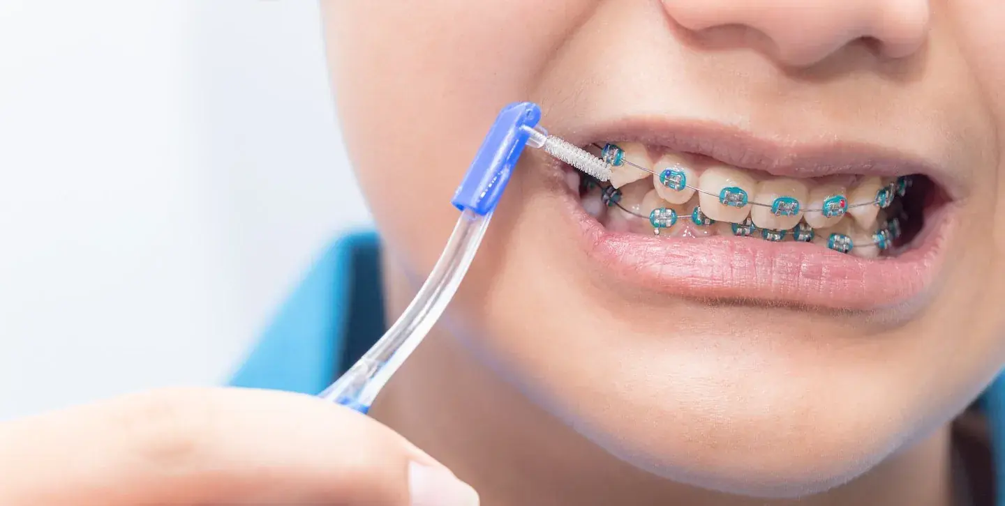 niềng răng có đánh răng được không