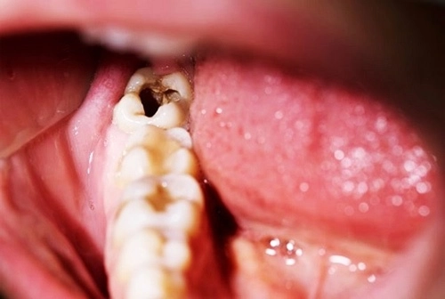 răng khôn bị sâu nên nhổ hay trám