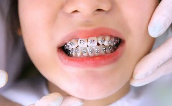 niềng răng mắc cài kim loại
