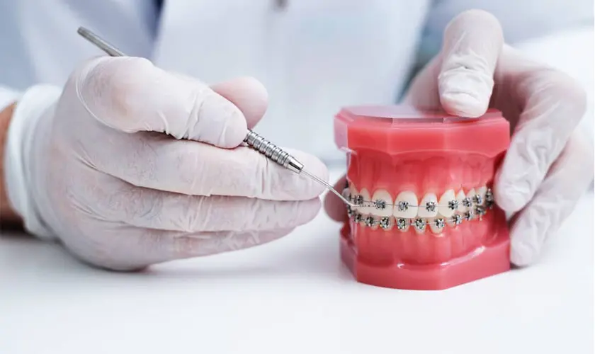 niềng răng mắc cài kim loại