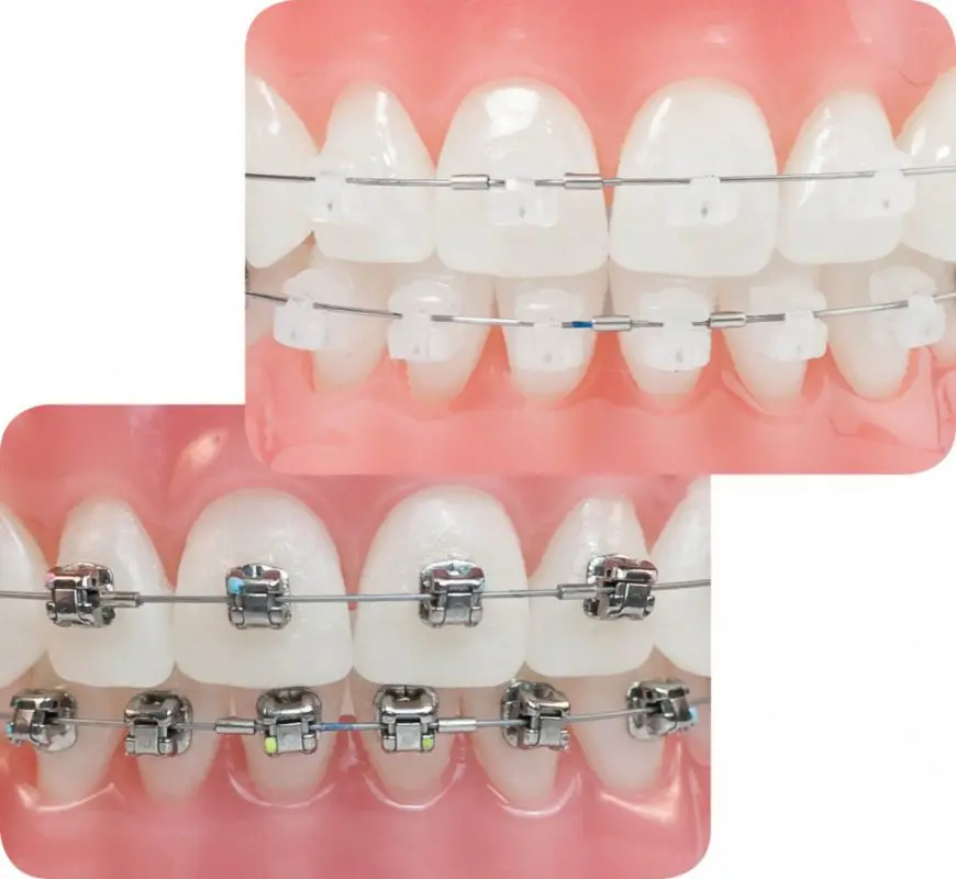 niềng răng mắc cài kim loại