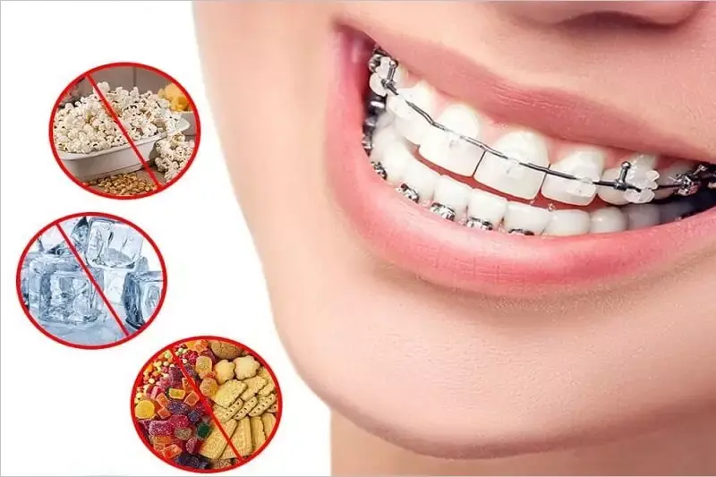 niềng răng mắc cài kim loại