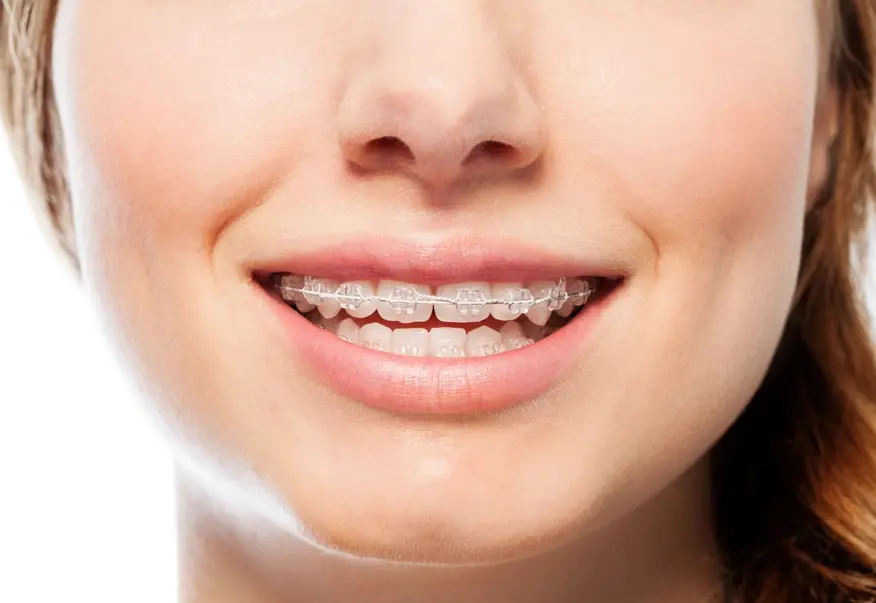 Niềng Răng Mắc Cài Sứ Giá Bao Nhiêu