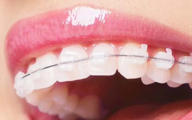 Niềng Răng Mắc Cài Sứ Giá Bao Nhiêu
