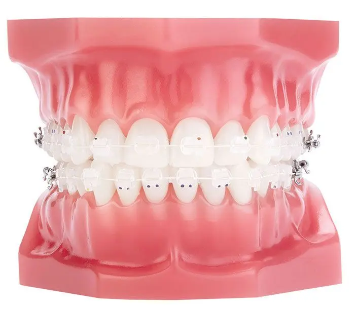 Niềng Răng Mắc Cài Sứ Giá Bao Nhiêu