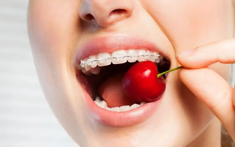 Niềng Răng Mắc Cài Sứ Giá Bao Nhiêu