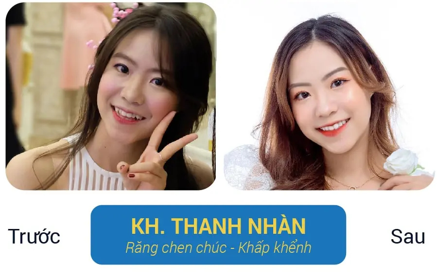 Niềng Răng Mắc Cài Sứ Giá Bao Nhiêu