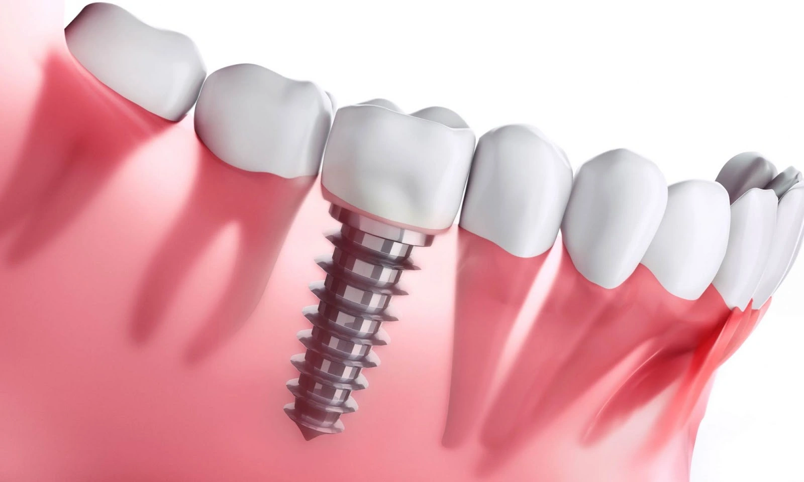 làm răng implant