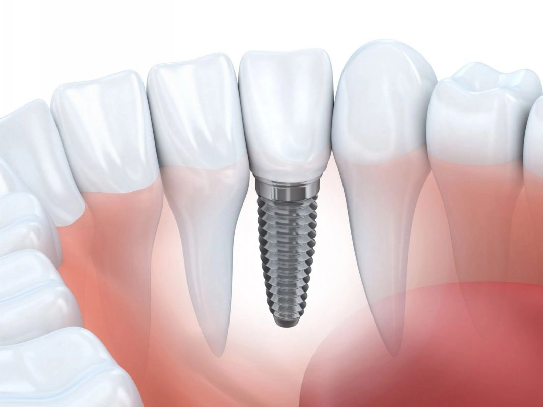 trồng răng implant