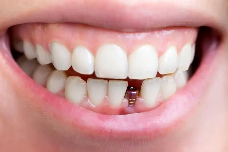 giá trồng implant