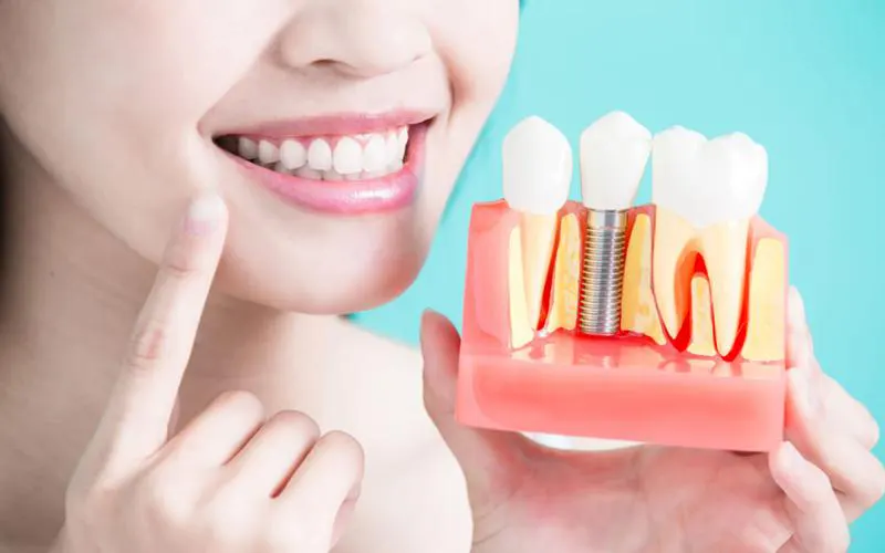 chi phí trồng răng implant