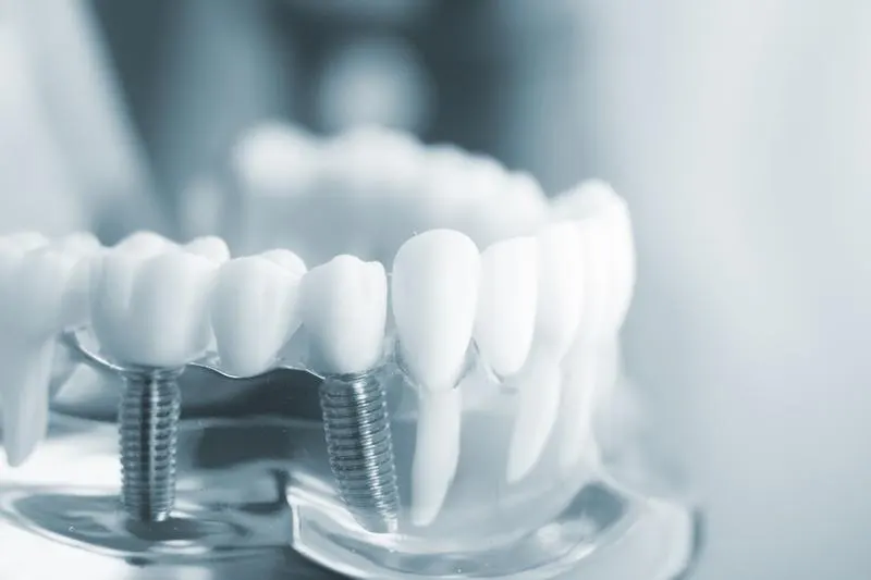 trồng implant giá