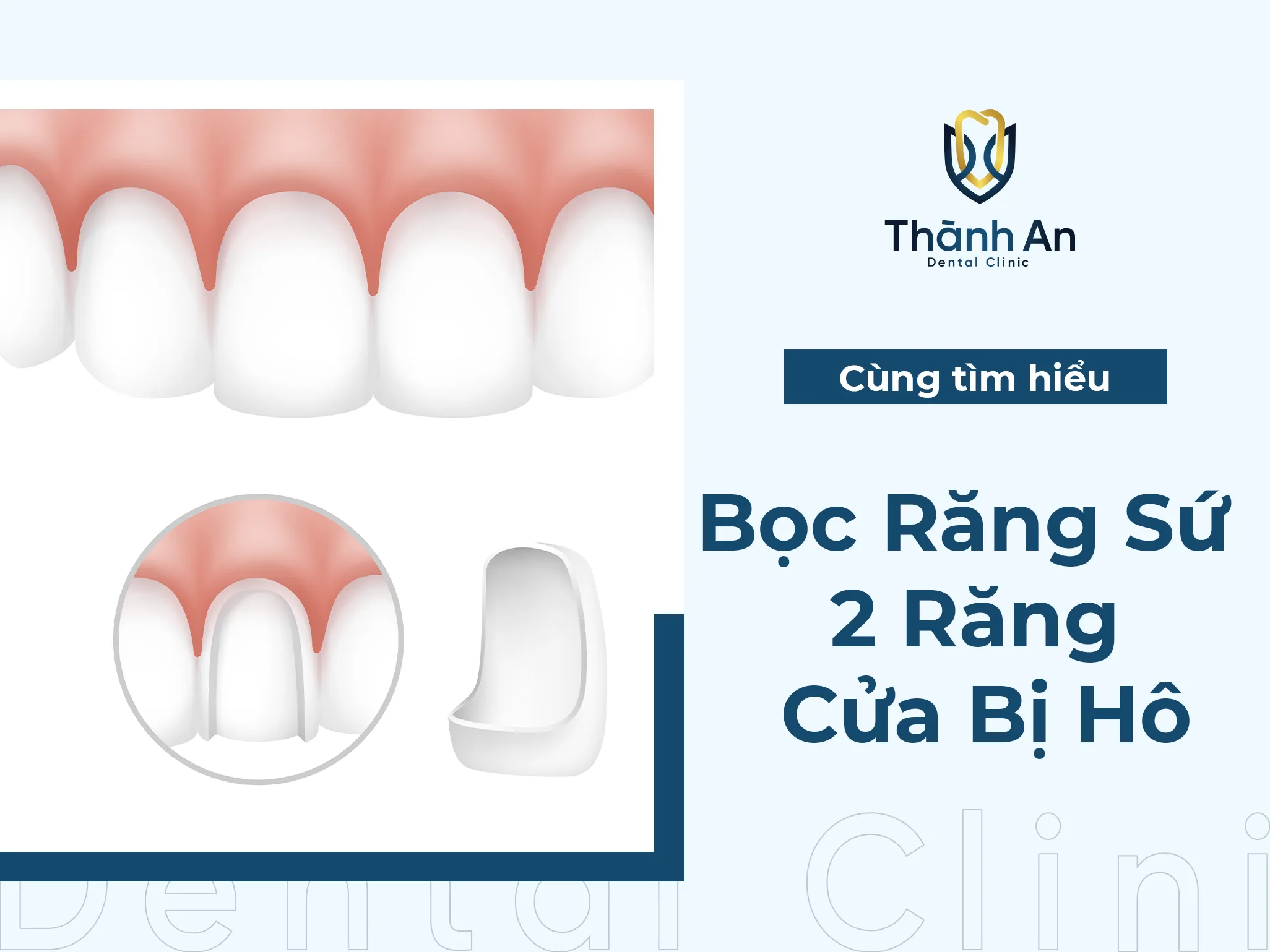 Bọc Răng Sứ 2 Răng Cửa Bị Hô Giải Pháp Điều Trị Hiệu Quả