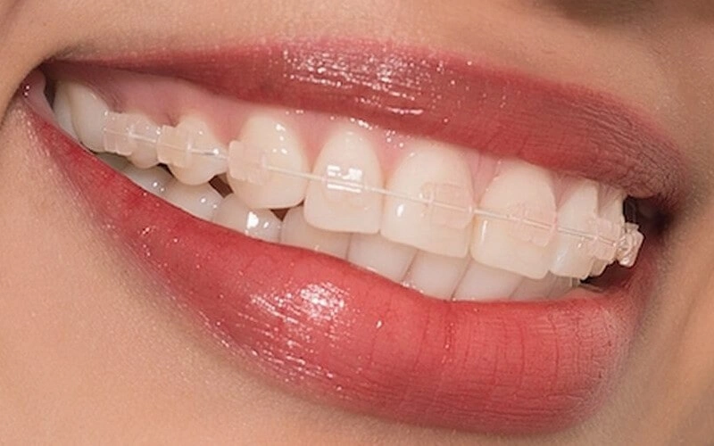 Niềng Răng Mắc Cài Sứ Là Gì