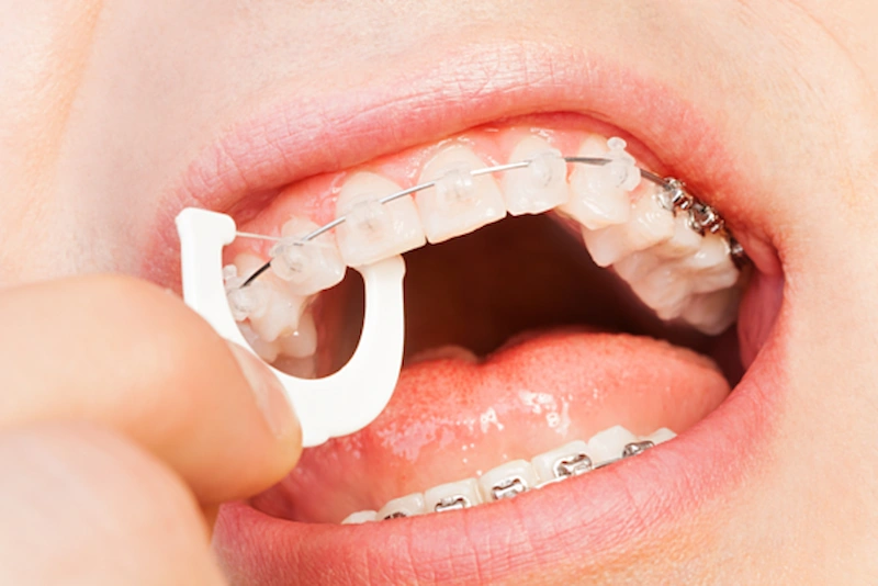 thời gian Niềng Răng Mắc Cài Sứ