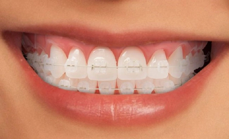 Niềng Răng Mắc Cài Sứ Là Gì