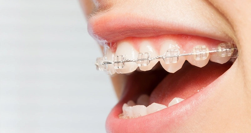 Niềng Răng Mắc Cài Sứ Là Gì